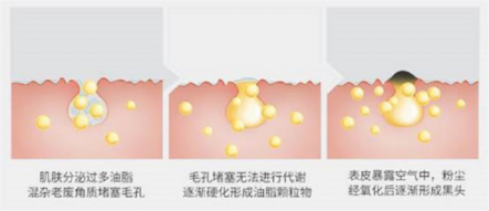 還鼻子一片“白凈”，黑頭儀有用嗎？