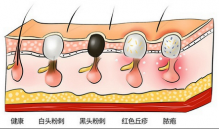 讓黑頭乖乖跑出來，黑頭儀有用嗎？