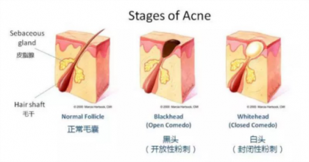 黑頭儀有用嗎？用了它終于擺脫了頑固黑頭！