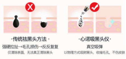 黑頭儀有用嗎？用了它終于擺脫了頑固黑頭！