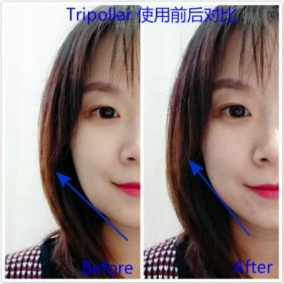 雅萌、GEVILAN歌嵐、Tripollar、NEWA美容儀到底選哪個？先評測一下再說