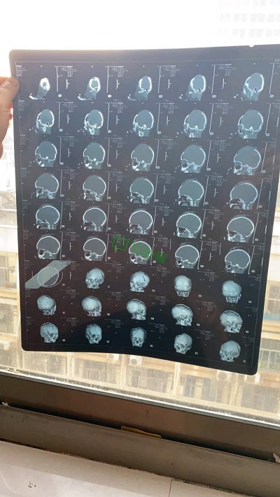 湖南婁底6歲女童遭男子揮鋤頭砸傷，輕松籌上已籌集百萬愛心善款