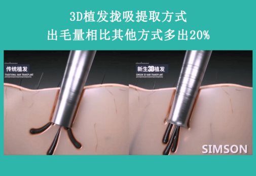 雙12熬夜搶防脫產(chǎn)品？重慶新生植發(fā)：植養(yǎng)護(hù)搭配更靠譜