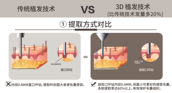 廈門新生植發(fā)：脫發(fā)人數(shù)超2.5億，雙十二消費(fèi)報(bào)告植發(fā)數(shù)據(jù)爆增