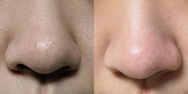 HomeFacialPro乳糖酸鼻貼真實(shí)使用效果測(cè)評(píng)，草莓鼻救星來(lái)了