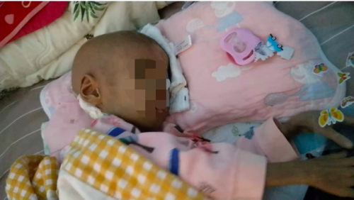 4歲女童得罕見病只有11斤，高昂費用壓垮母親，水滴愛心接力帶來希望