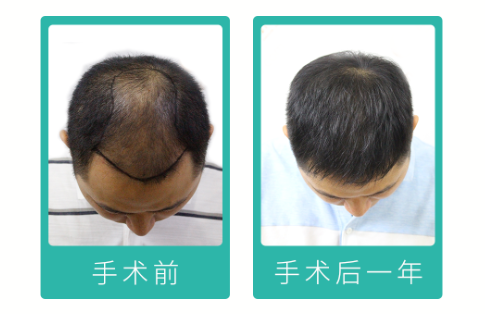 90后“禿”然崛起，常州新生植發(fā)：3D植發(fā)技術(shù)備受關(guān)注