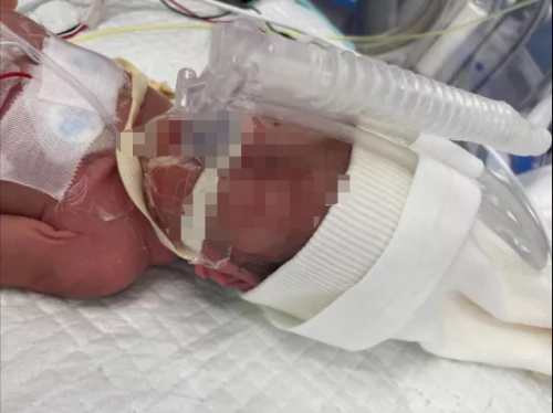 孩子剛出生就住進(jìn)ICU，水滴籌筑起生命長城