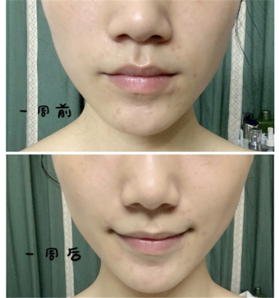 抗糖化能祛痘？HFP肌肽原液開箱使用一周真實效果測評